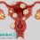 hirslanden-illustration-endometeriose-uterus
